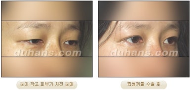 [두한성형외과 쌍커풀수술] - [매력적인 쌍커풀] 관련 이미지 19