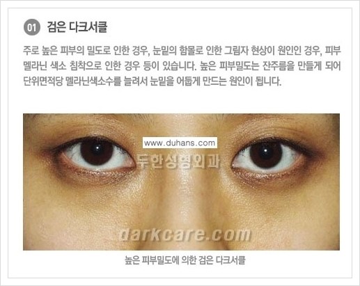 [두한성형외과 경쟁력 눈밑성형] - [다크써클의 종류] 관련 이미지 7