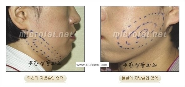 [두한성형외과 경쟁력 지방흡입] - [얼굴, 볼살, 턱살, 턱선의 초음파 지방흡입] 관련 이미지 7