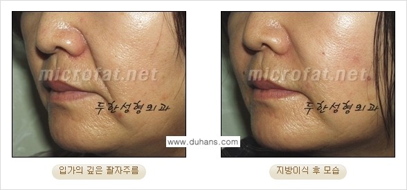 [두한성형외과의 경쟁력 있는 지방이식] - [입가주름, 팔자주름 미세지방이식 1.] 관련 이미지 10