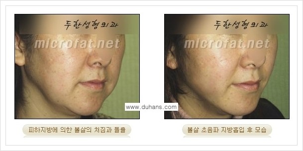 [두한성형외과 겨울엔 지방흡입을] - [볼살, 눈밑, 턱선의 초음파 미세지방흡입 2.] 관련 이미지 11
