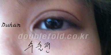 [두한성형외과 쌍커풀재수술] - [개인의 눈매와 특성에 맞는 쌍커풀재수술] 관련 이미지 26