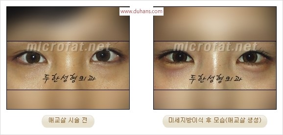 ​﻿[두한성형외과 경쟁력 지방이식] - [눈밑 애교살 시술을 위한 미세지방이식] 관련 이미지 29