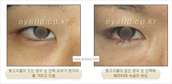 [두한성형외과 경쟁력 눈성형] - [흉터없는 몽고주름 제거술(앞트임) 관련 이미지 2