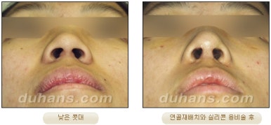 [두한성형외과 코재수술] - [코성형 안내] 관련 이미지 22