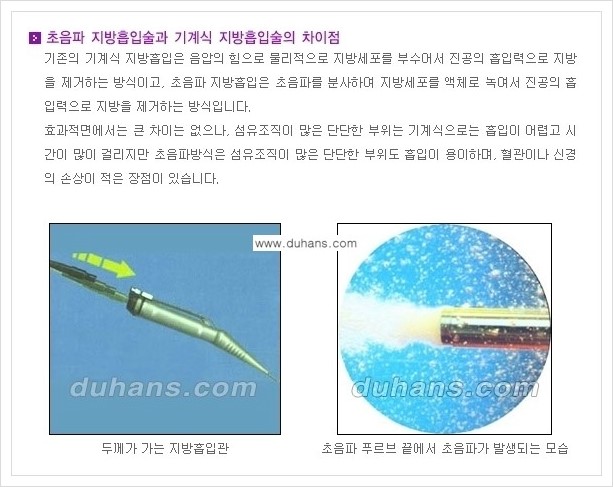 [두한성형외과 경쟁력 초음파 간편지방흡입] - [복부지방흡입, 허벅지지방흡입, 엉덩이지방흡입, 팔뚝지방흡입 안내] 관련 이미지 8