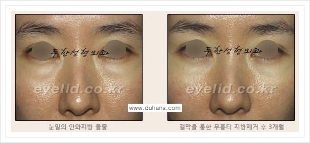 [두한성형외과 경쟁력 지방제거] - [눈꺼풀 지방제거 흔한 질문과 답변 모음] 관련 이미지 2