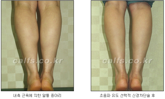 [두한성형외과 종아리퇴축술] - [NO절개! 초음파유도신경차단술] 관련 이미지 37