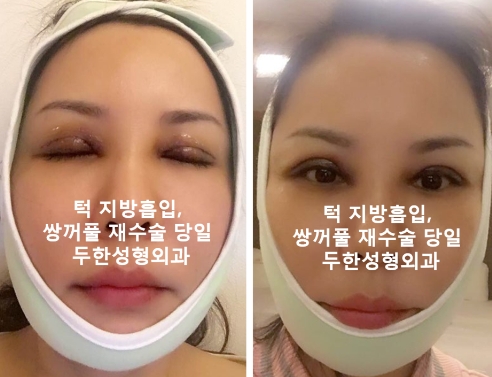[두한성형외과] - [쌍꺼풀재수술, 눈꺼풀처짐, 상안검, 턱지방흡입, 불독살] 관련 이미지 5