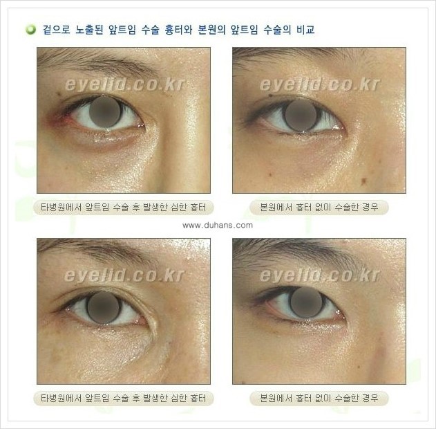 [두한성형외과 경쟁력 눈성형] - [눈성형, 쌍꺼풀 수술 방법에 관한 자주하는 질문과 답변 안내] 관련 이미지 16