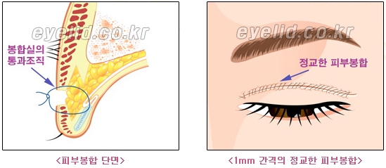 [두한성형외과 쌍꺼풀재수술] - [쌍꺼풀재수술성공요건, 쌍꺼풀재수술과정] 관련 이미지 9