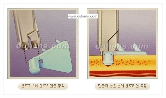 [두한성형외과 경쟁력 주름성형] - [엔도타인 리프팅 안내 ②] 관련 이미지 9