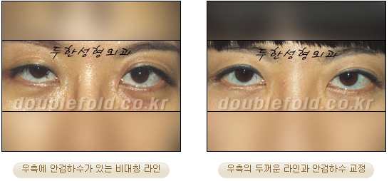 [Duhan Plastic Surgery Double Eyelid Revision Surgery] - [Ptosis Correction Surgery] image 47