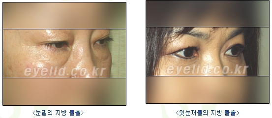 [두한성형외과 지방제거] - [눈두덩이지방제거, 눈밑지방제거] 관련 이미지 2