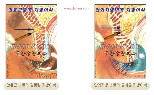 [두한성형외과 경쟁력 눈성형 리더] - [윗눈꺼풀 함몰( #꺼진눈꺼풀) 미세지방이식과 상안검성형]#꺼진눈성형 , #눈위함몰 관련 이미지 4