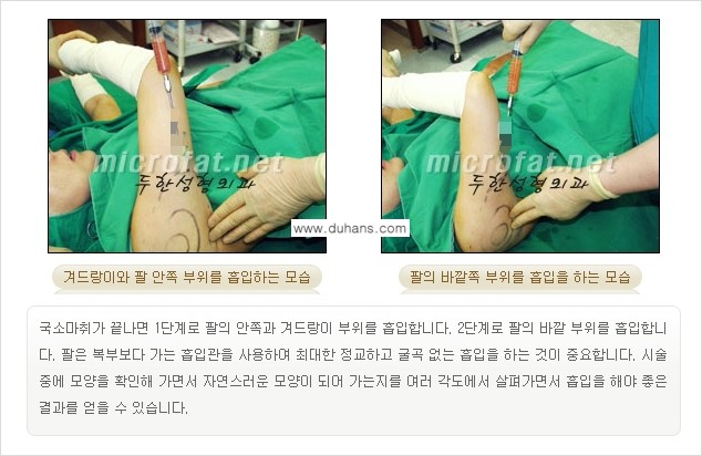 [두한성형외과 간편 지방흡입] - [복부지방흡입 안내 2.] 관련 이미지 8