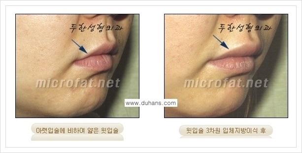[두한성형외과 경쟁력 미세지방이식] - [입술 미세지방이식 안내 2.] 관련 이미지 6