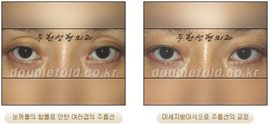 눈성형잘하는곳 두한성형외과 - 겹쌍꺼풀 관련 이미지 35