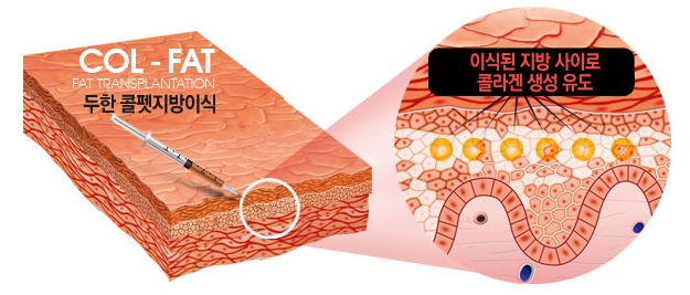 [Fat Grafting Duhan Plastic Surgery] - [Side Effects of Fat Grafting] image 2