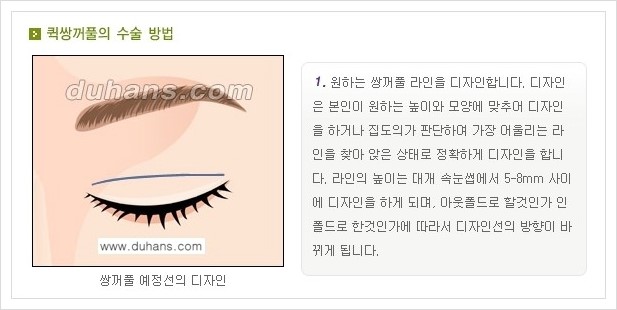 ⁠⁠[두한성형외과 경쟁력 눈성형] - [퀵쌍꺼풀(부분절개법)의 수술 방법 안내] 관련 이미지 1