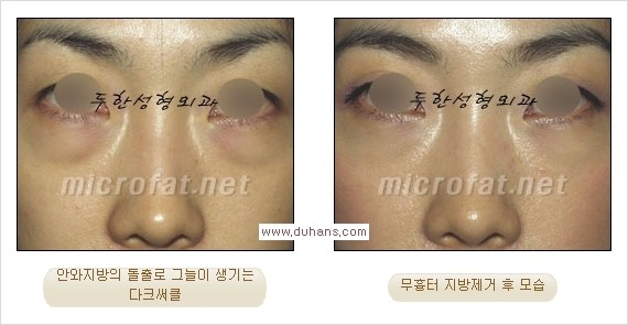[두한성형외과 경쟁력 눈밑성형] - [과도한 눈밑지방제거의 부작용 후 눈밑지방재배치] 관련 이미지 10