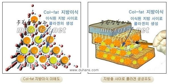 [두한성형외과 자가지방이식] - [3차원 미세지방이식] 관련 이미지 8