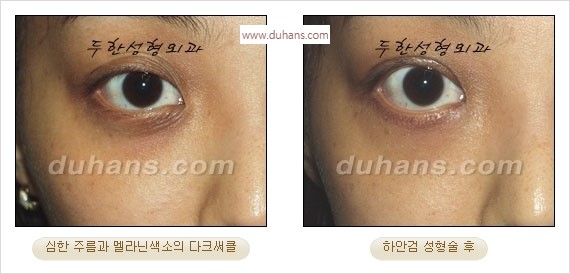 [두한성형외과 경쟁력 안검성형] - [눈밑주름 제거수술] 관련 이미지 16