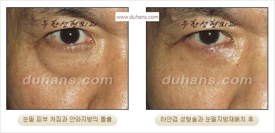 [두한성형외과 경쟁력 안검성형] - [젊어 보이면서 개선된 인상을 주기 위한 성형] 관련 이미지 31