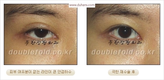 [두한성형외과 경쟁력 눈성형] - [극한 재수술, 함몰된 눈꺼풀 라인교정, 안검하수(졸리운 눈매)] 관련 이미지 22