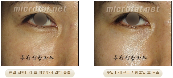 [Duhan Plastic Surgery Liposuction] - [Facial Liposuction] image 24