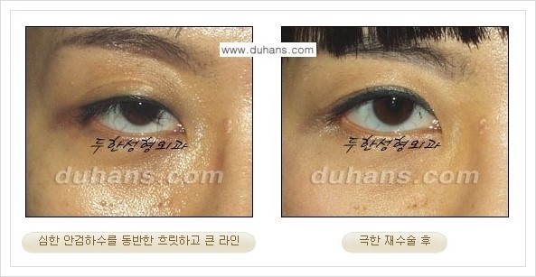 [두한성형외과 경쟁력 망가진 눈 복원수술] - [두꺼운 라인을 교정하는 극한 재수술(Extreme Reoperation) 안내] 관련 이미지 11