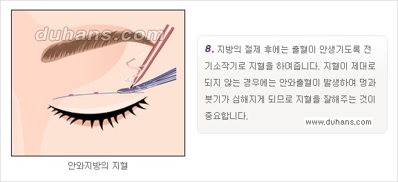 ​[두한성형외과 경쟁력 눈성형] - [자연스럽고 아름다운 쌍꺼풀의 기준] 관련 이미지 14