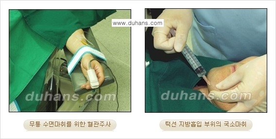 ​​​﻿[두한성형외과 경쟁력 간편지방흡입] - [볼살지방흡입, 턱선지방흡입 안내] 관련 이미지 5