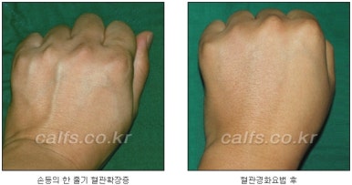 두한성형외과 보기싫은 혈관제거 - 눈밑혈관, 손과 팔의 혈관확장증 치료 관련 이미지 30