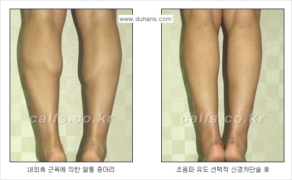 ​[두한성형외과와 날씬한 종아리 만들기!] - [간편하고 안전한 종아리 축소방법 ④] 관련 이미지 3
