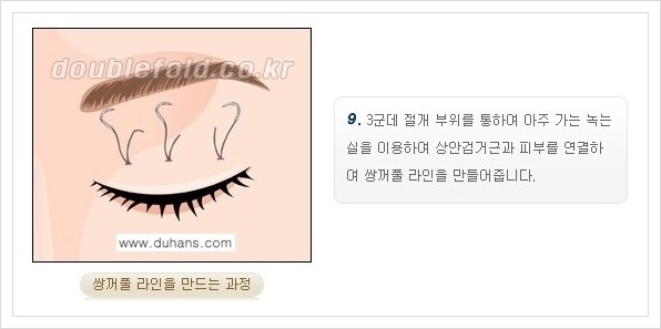 [두한성형외과 경쟁력 쌍꺼풀 재수술, 극한 재수술] - [쌍꺼풀 재수술의 과정 안내 1.] 관련 이미지 20