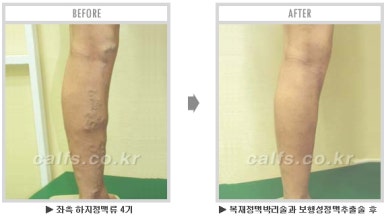 [종아리 두한성형외과] - [나에게 맞는 종아리시술] 관련 이미지 71