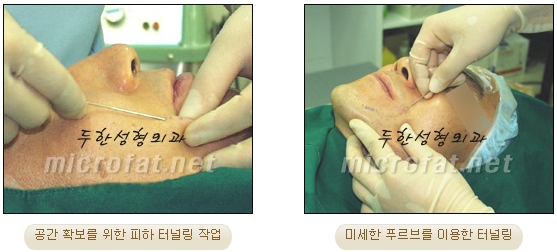 [Duhan Plastic Surgery Double Eyelid Revision Surgery] - [Correcting the Double Eyelid Line in Sunken Eyelids] image 55