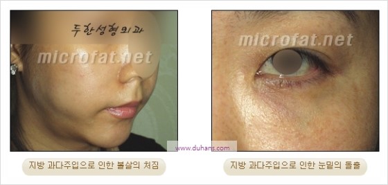 [두한성형외과 경쟁력 지방이식] - [두한 자가지방이식 클리닉 안내]​ 관련 이미지 55