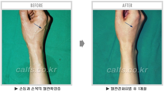 [종아리성형 두한성형외과] - [종아리수술에 대한 자주하는 질문과 답변 모음] 관련 이미지 41