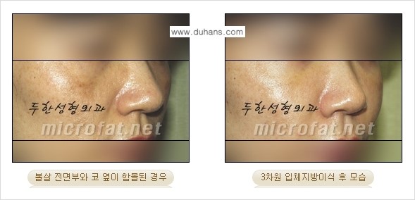 [두한성형외과의 경쟁력 미세지방이식] - [귀족수술과 인디언밴드 미세지방이식 안내 ③] 관련 이미지 3