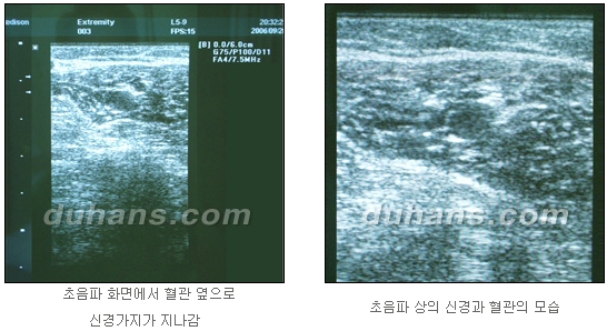 [두한성형외과 종아리 퇴축] - [종아리 퇴축술 재발 재수술] 관련 이미지 10