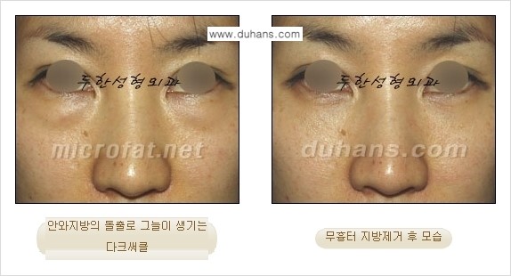 [두한성형외과 젊은 눈매 안검성형] - [눈밑 지방제거의 수술 전후 안내 ①] 관련 이미지 8