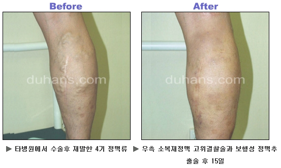 [두한성형외과 정맥류] - [하지정맥류, 정맥확장증, 혈관확장증] 관련 이미지 31
