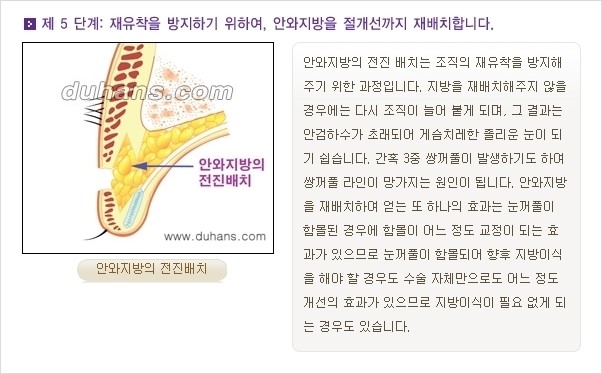 [두한성형외과 경쟁력 눈성형] - [쌍꺼풀 재수술 방법 - 완전절개법(Full incision method) 과정 안내] 관련 이미지 6