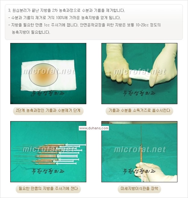 [두한성형외과 경쟁력 미세지방이식] - [타병원에서의 미세지방이식 이후 부작용 교정의 대상 안내] 관련 이미지 19