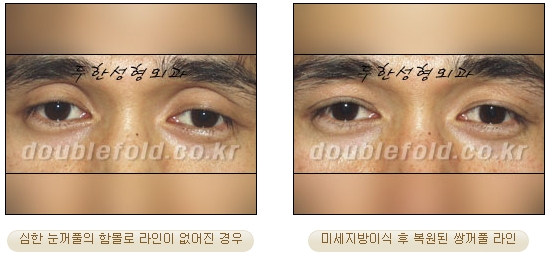 [두한성형외과 쌍커풀수술] - [눈성형 방법에 대한 자주하는 질문과 답변] 관련 이미지 104