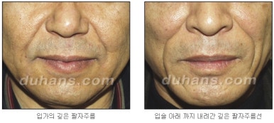 [Wrinkle Correction, Duhan Plastic Surgery] - [Wrinkle Botox, Wrinkle Filler, Wrinkle Fat Grafting] image 33