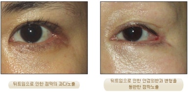 [Duhan Plastic Surgery Eyelid Surgery] - [Epicanthoplasty, Medial Canthoplasty] image 16