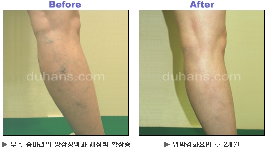 [두한성형외과 정맥류] - [하지정맥류, 정맥확장증, 혈관확장증] 관련 이미지 46